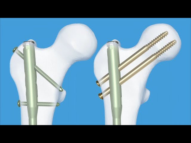 AUTOBAHN® Femoral Nailing System | Globus Medical